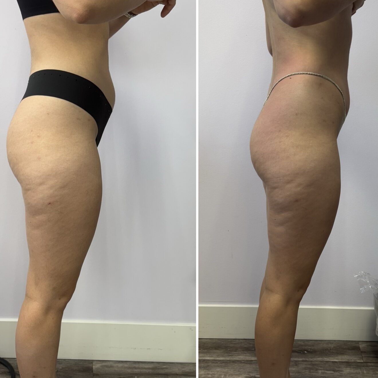 Before and after body contouring, side view of hips and thighs