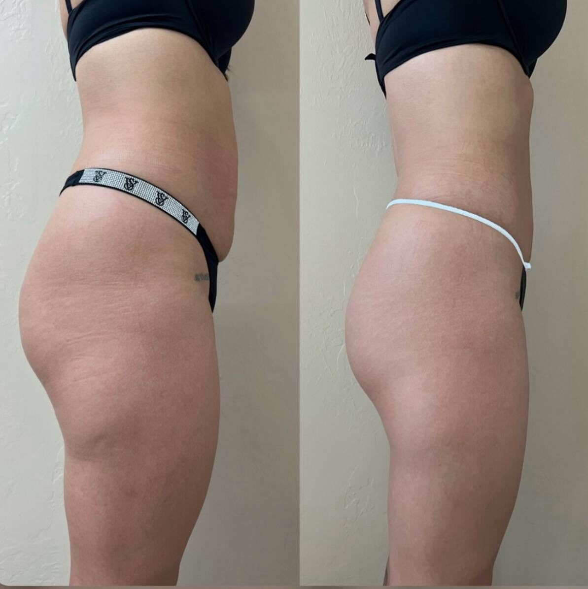 Before and after body contouring, side view of waist and hips