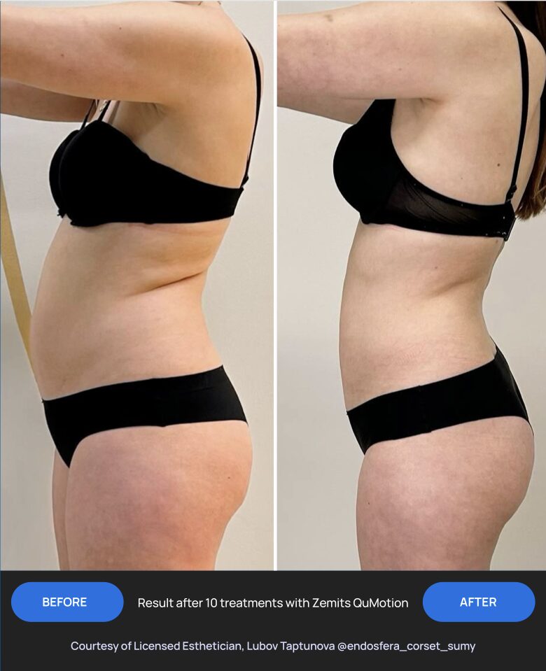Before and after 10 treatments with Zemits QuMotion