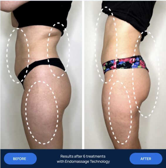 Before and after 6 endomassage treatments, waist and thighs