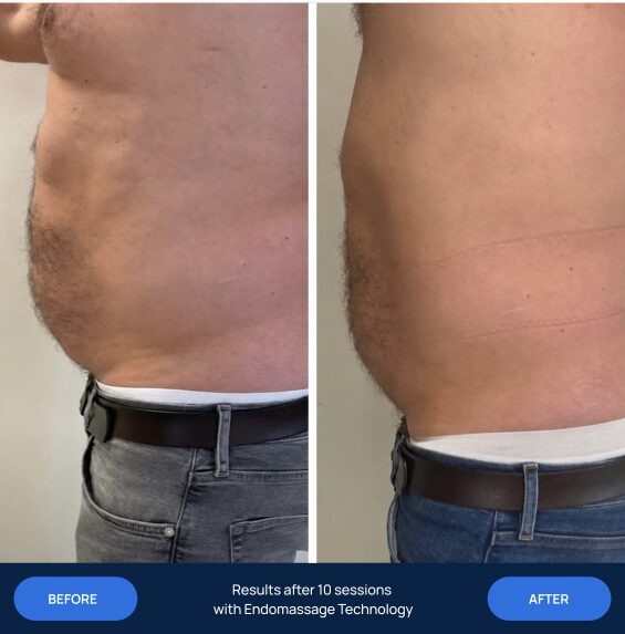 Before and after 10 endomassage sessions, abdomen